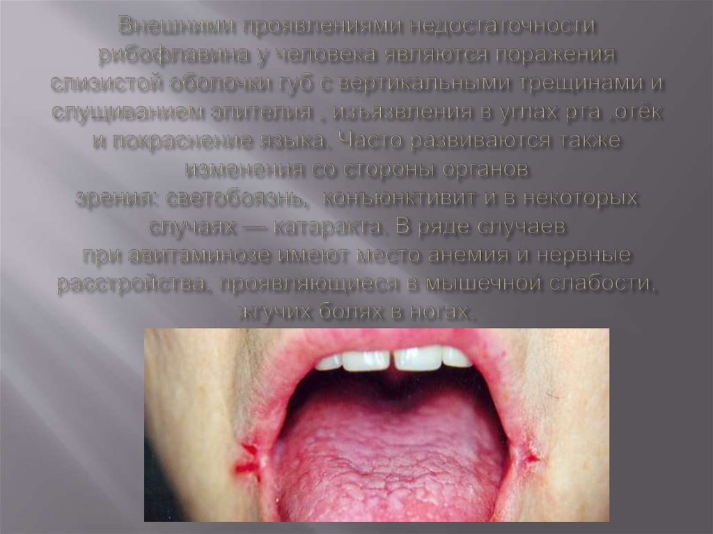 Внешними проявлениями недостаточности рибофлавина у человека являются поражения слизистой оболочки губ с вертикальными