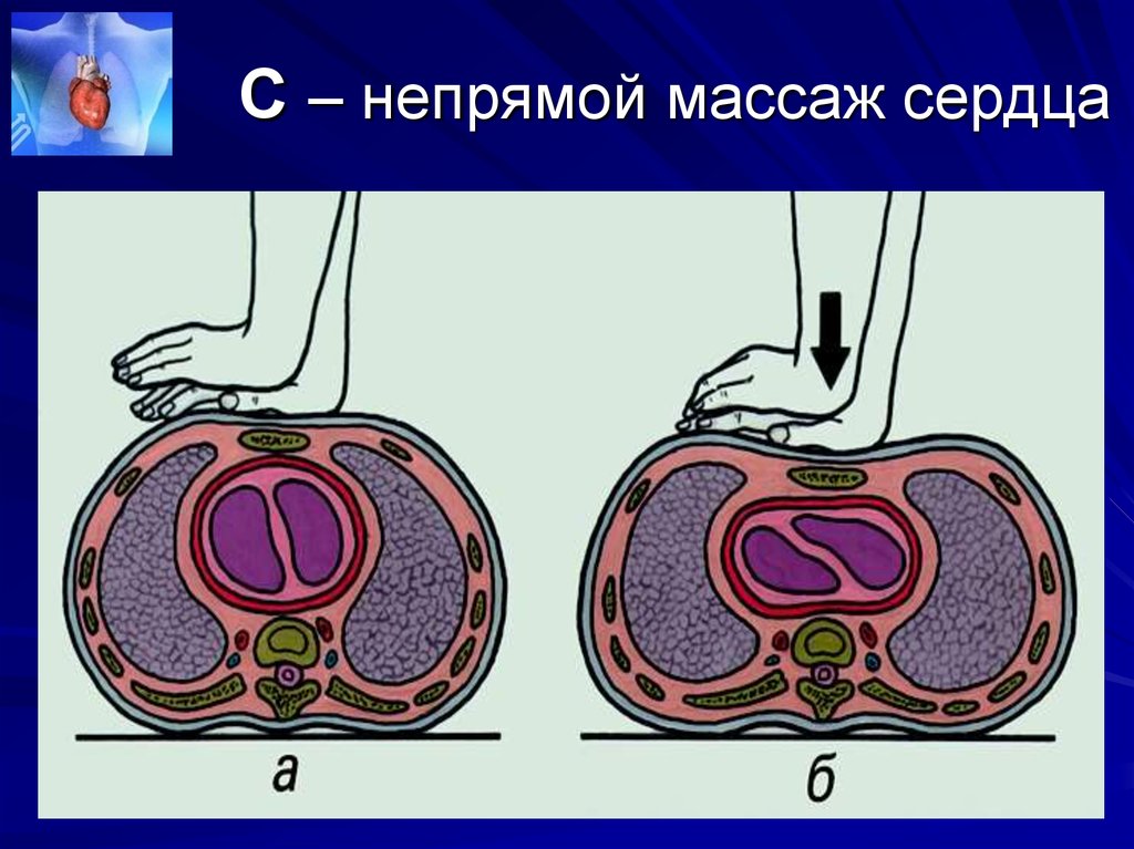 Непрямой массаж сердца двумя людьми