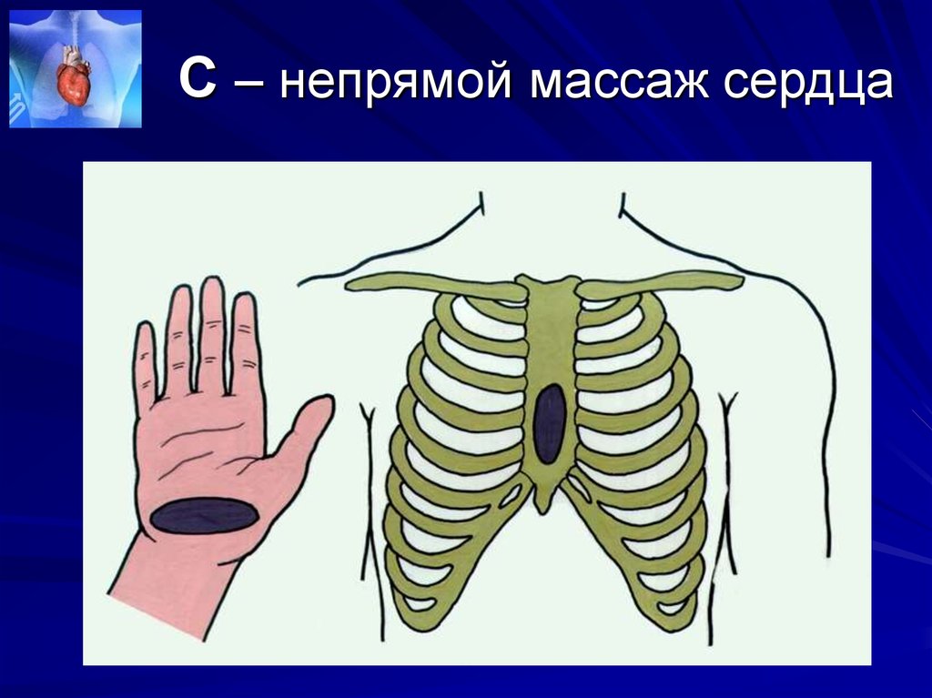 Непрямой массаж сердца схема