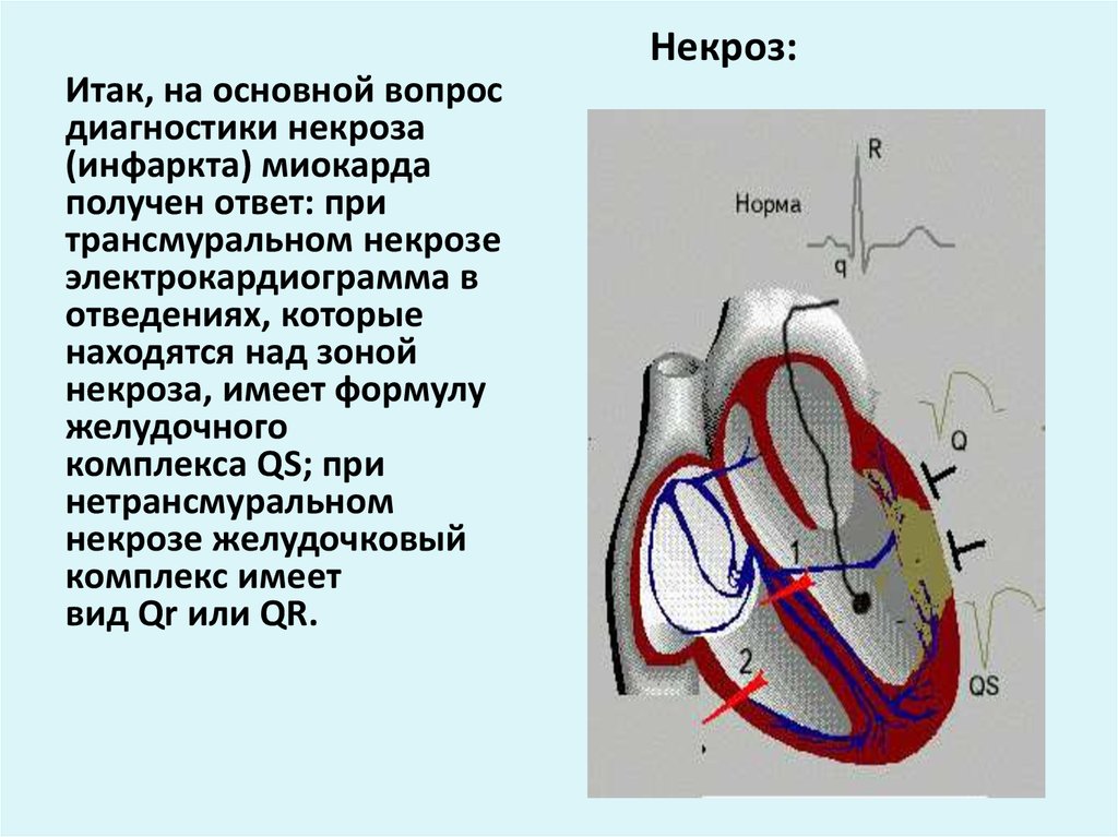 Нарушение стенки миокарда