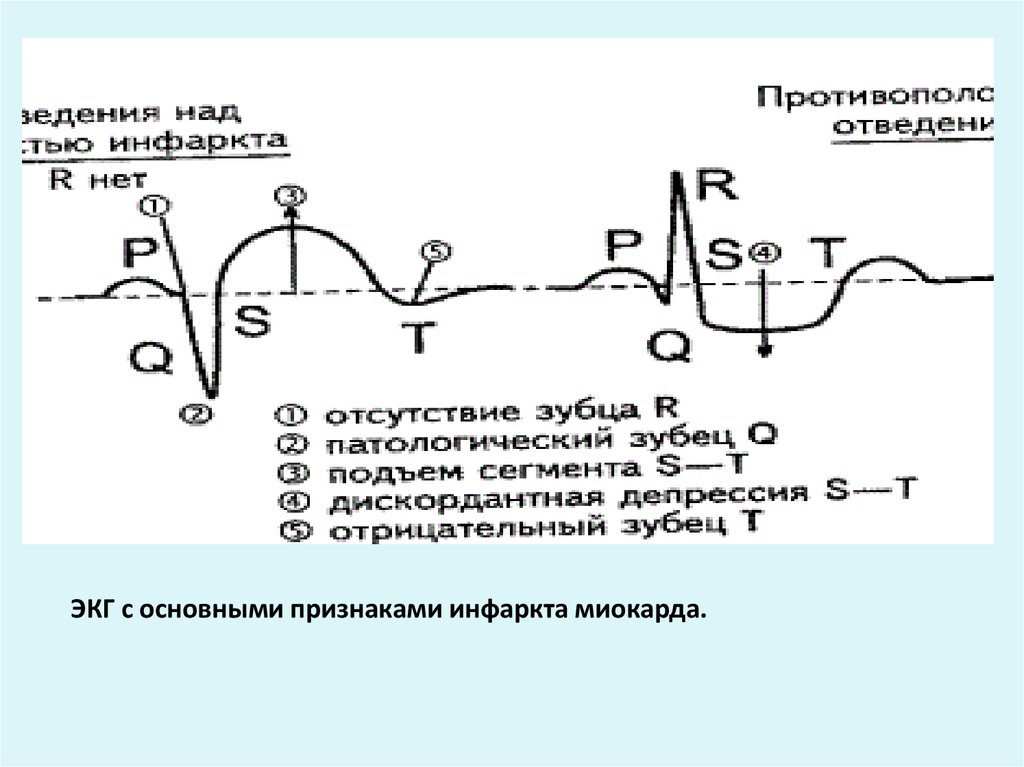 Экг признаки инфаркта миокарда. Основной признак инфаркта миокарда на ЭКГ. ЭКГ критерии инфаркта миокарда. Признаки инфаркта на ЭКГ.