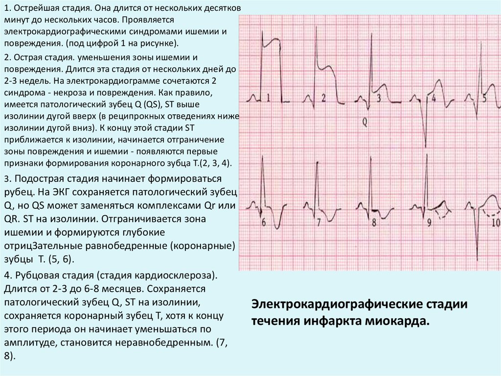 Очаговые изменения на экг. Постинфарктный кардиосклероз на ЭКГ. Стадия 1 при инфаркте миокарда на ЭКГ. ЭКГ инфаркт миокарда с подъемом St переднеперегородочный. ЭКГ критерии инфаркта миокарда с подъемом St.