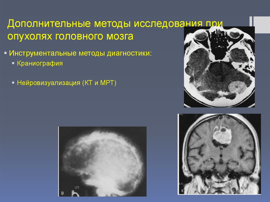 Виды опухолей головного. Методы исследования при опухоли головного мозга. Дополнительные методы исследования опухолей головного мозга. Диагноз кт с опухолью головного мозга. Дополнительные методы исследования при опухолях головного мозга.