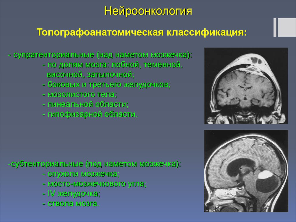 Клиническая картина опухоли головного мозга