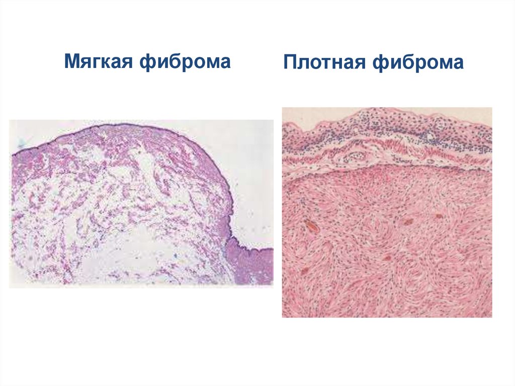 Фиброма микропрепарат рисунок