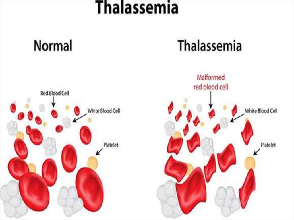 Талассемия что это. Классификация бета талассемия. Талассемия бета талассемия. Бета талассемия патогенез. Талассемия клинические рекомендации педиатрия.