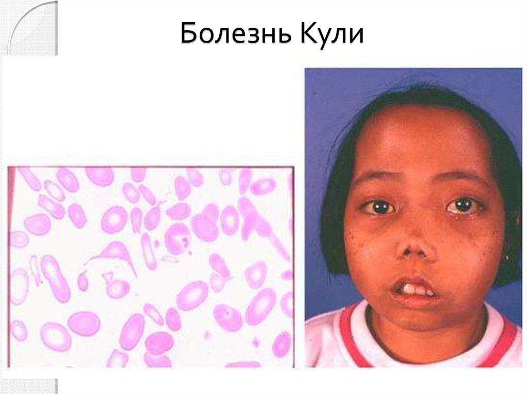 Болезнь Кули