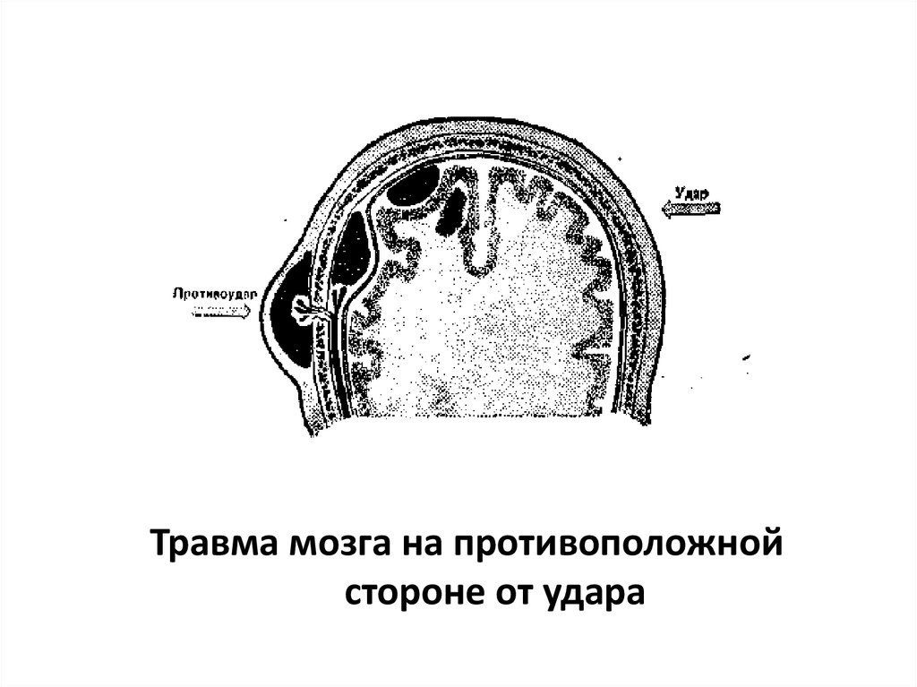 Травма мозга на противоположной стороне от удара