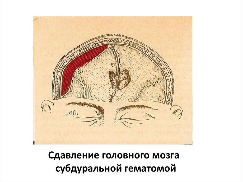 Сдавление головного мозга субдуральной гематомой