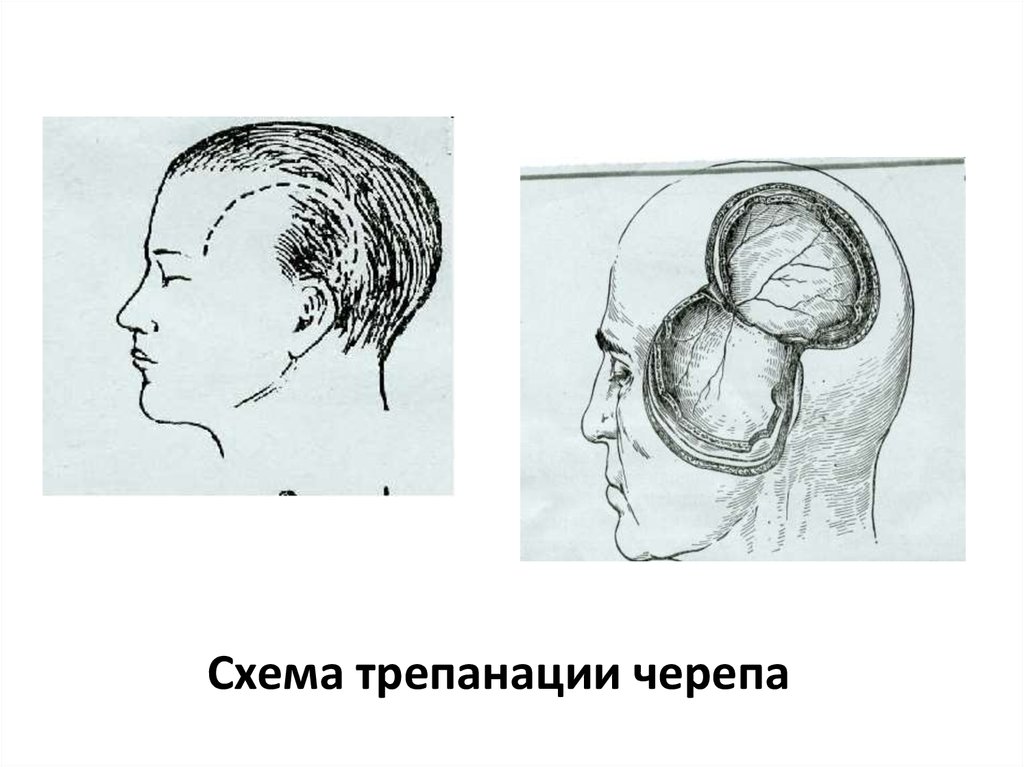 Костная трепанация