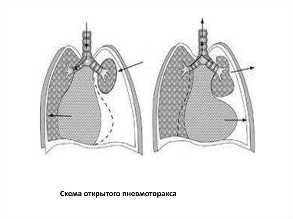 Схема открытого пневмоторакса