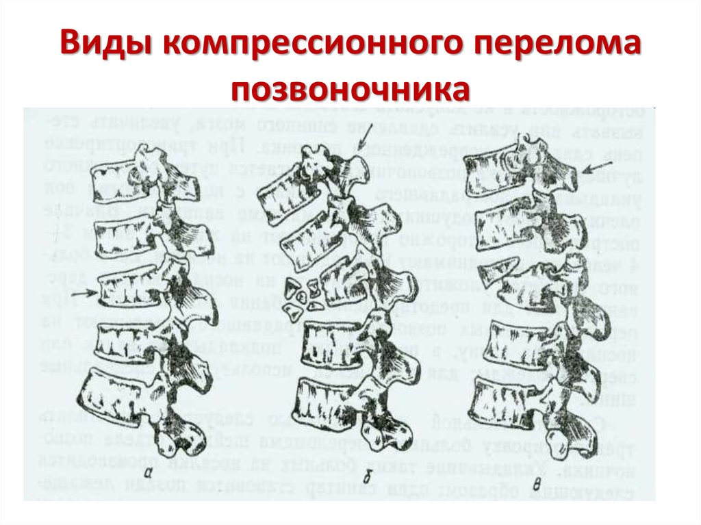 Перелом позвоночника карта вызова