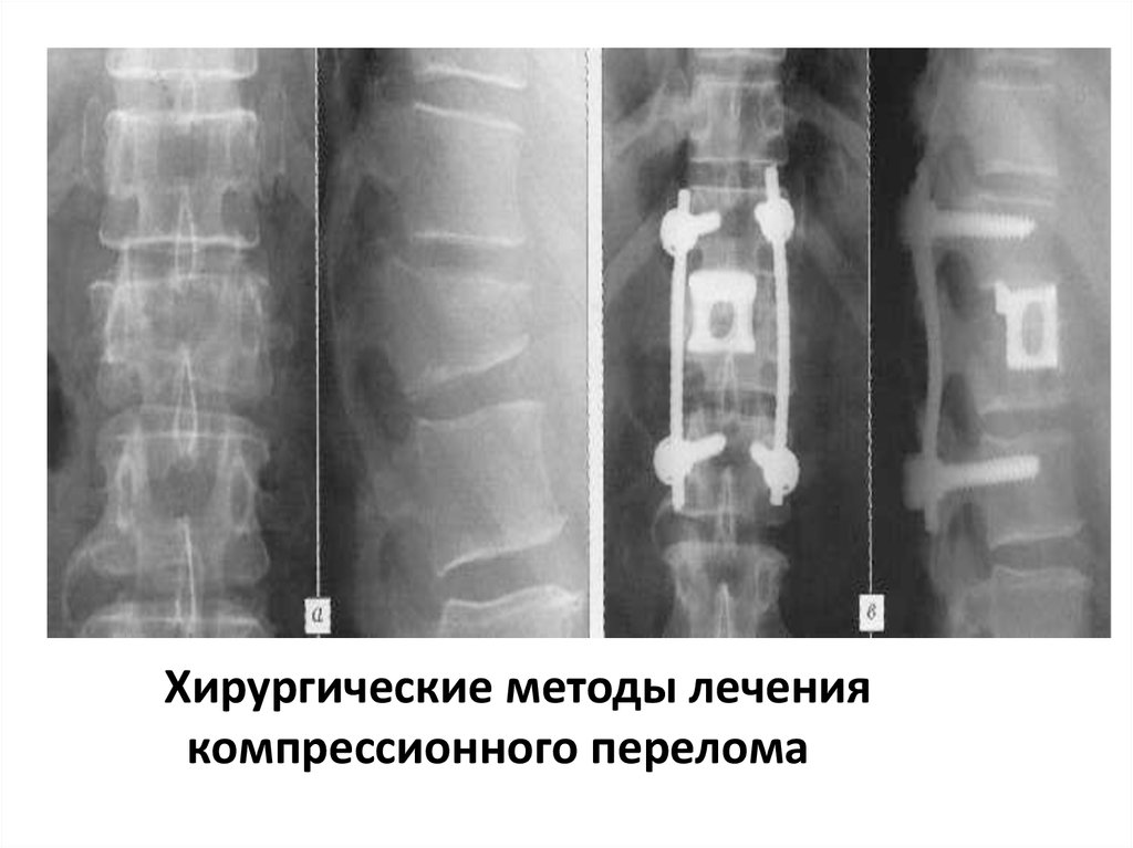 Перелом позвоночника лечение. Остеосинтез компрессионного перелома позвоночника. Компрессионный перелом позвоночника 12го позвонка. Перелом позвоночника остеосинтез рентген. Металлоостеосинтез при компрессионном переломе позвонка.