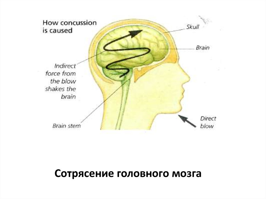 Светлый промежуток при черепно мозговой травме