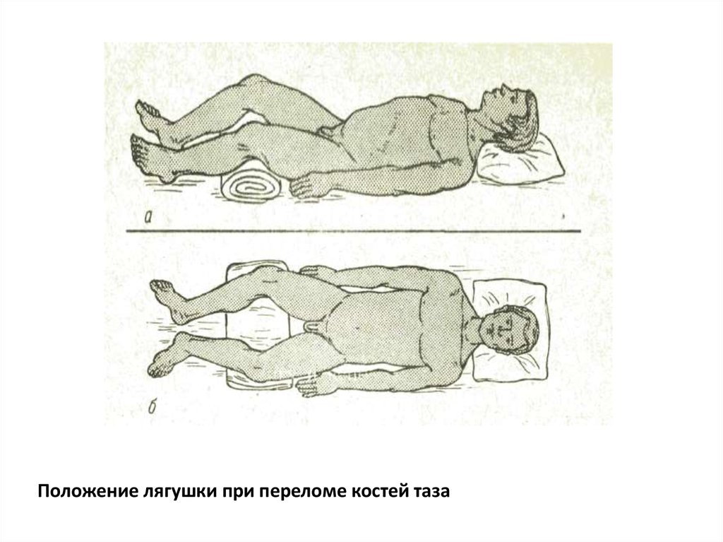 Положение костей. Положение лягушки при переломе костей таза. Перелом таза иммобилизация лягушка. Оказание ПМП при переломе таза. Положение лягушки при переломе костей.