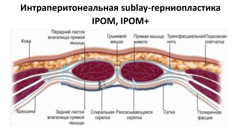 Грыжа брюшной стенки фото