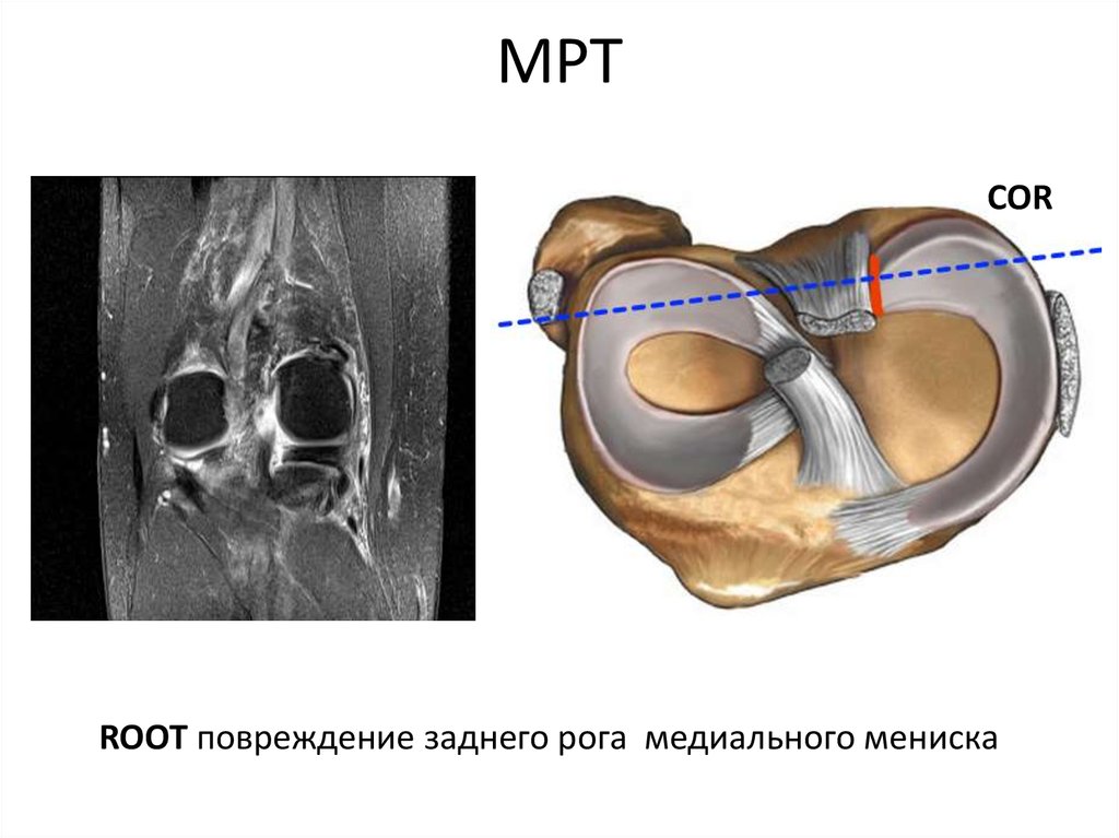 Повреждение мениска. Задний Рог наружного мениска коленного сустава. Задний Рог мениска коленного сустава. Задний Рог латерального мениска. Разрыв заднего рога мениска.