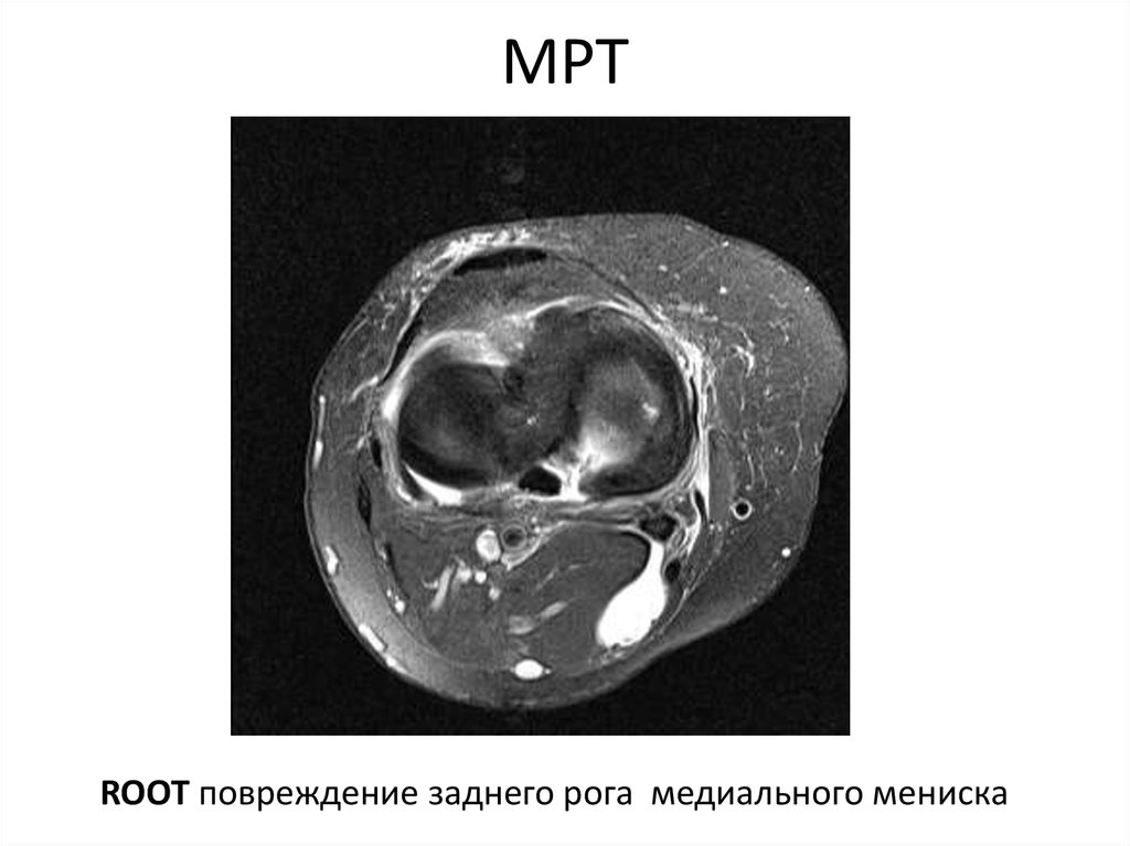 Разрыв мениска мрт