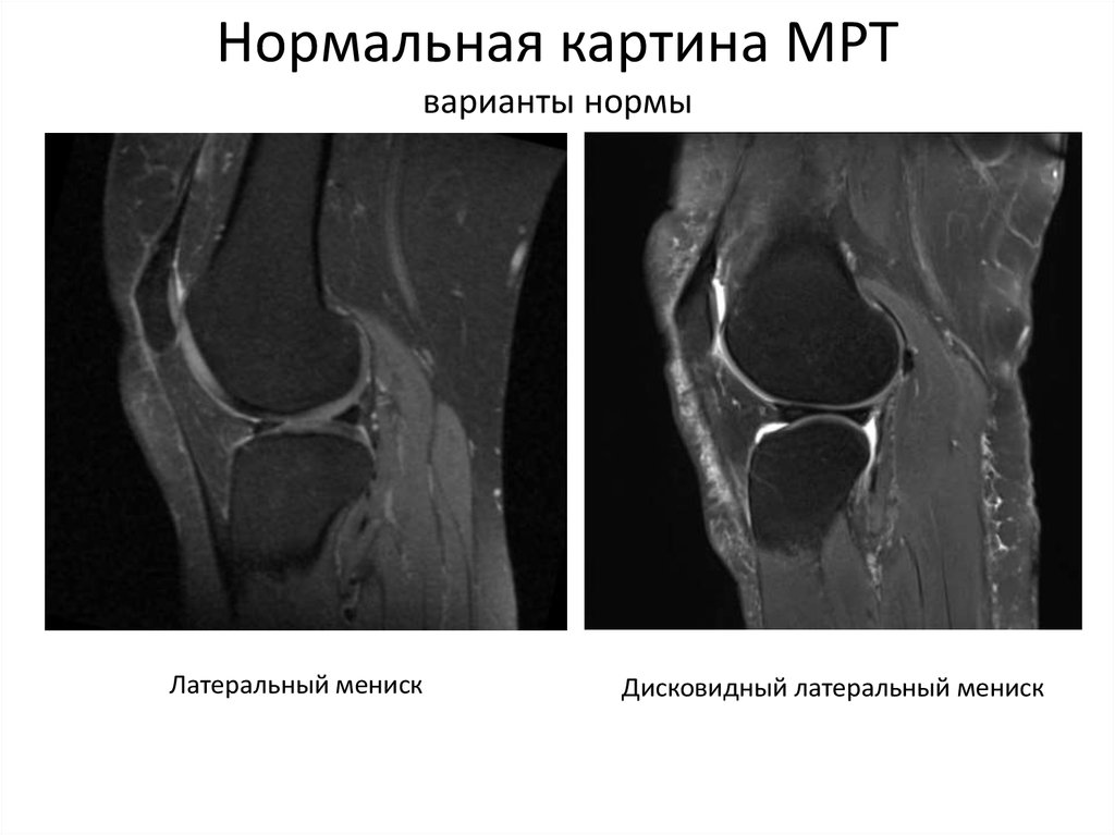 Дегенерация мениска