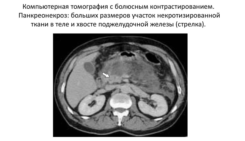 Кт картина панкреатита