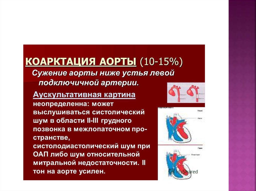 Коарктация аорты презентация