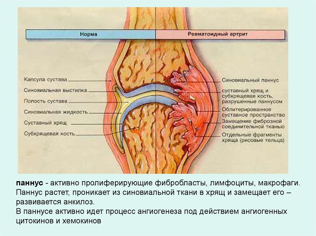 Ревматоидный артрит мышцы. Паннус ревматоидный артрит. Синовиальная оболочка паннус. Ревматоидный артрит суставной симптомы. Паннус коленного сустава.