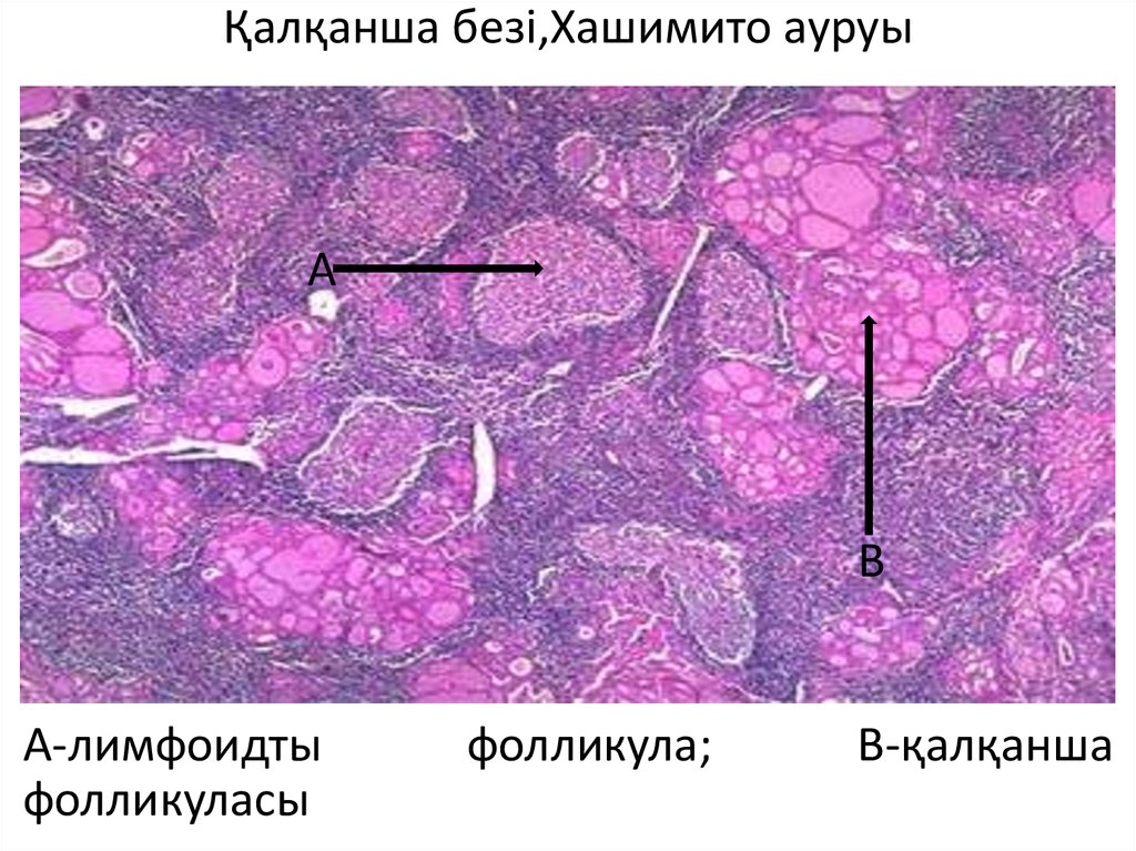 Щитовидная железа гиперплазия. Аутоиммунный тиреоидит зоб хассимото микрперапарат. Аутоиммунный тиреоидит зоб Хашимото микропрепарат. Аутоиммунный тиреоидит микропрепарат патанатомия. Тиреоидит Хашимото гистология.