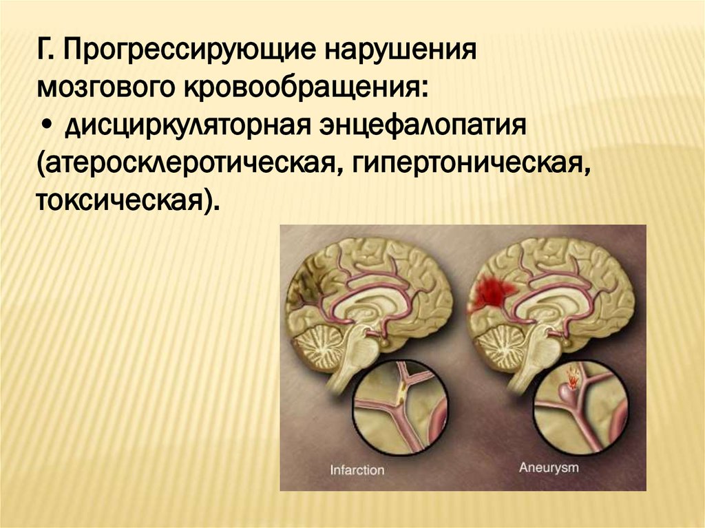 Сосудистые заболевания головного мозга