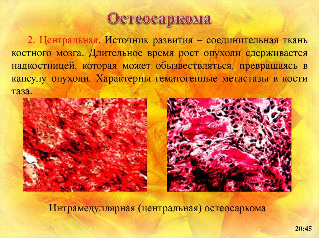 Опухоль костного мозга. Метастазирование опухоли в костный мозг. Первые гематогенные метастазы. Источники развития соединительной ткани. Гематогенные метастазы в кости.