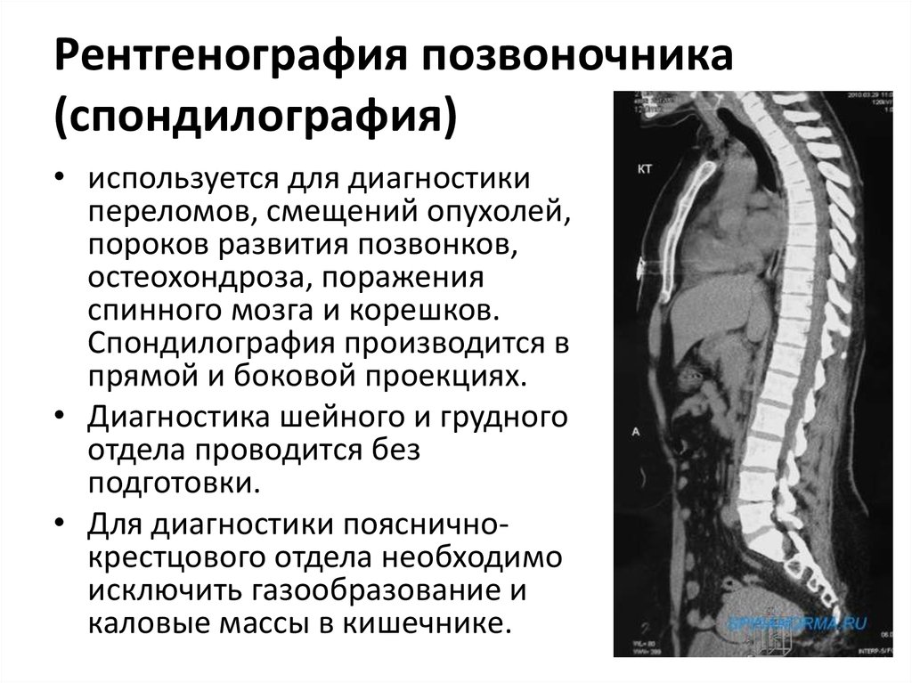 Диагноз грудного отдела позвоночника. Грудной отдел позвоночника рентген норма. Рентген здорового позвоночника грудного отдела. Рентген шейного отдела позвоночника в 2 проекциях. Рентген нормального позвоночника грудного отдела.