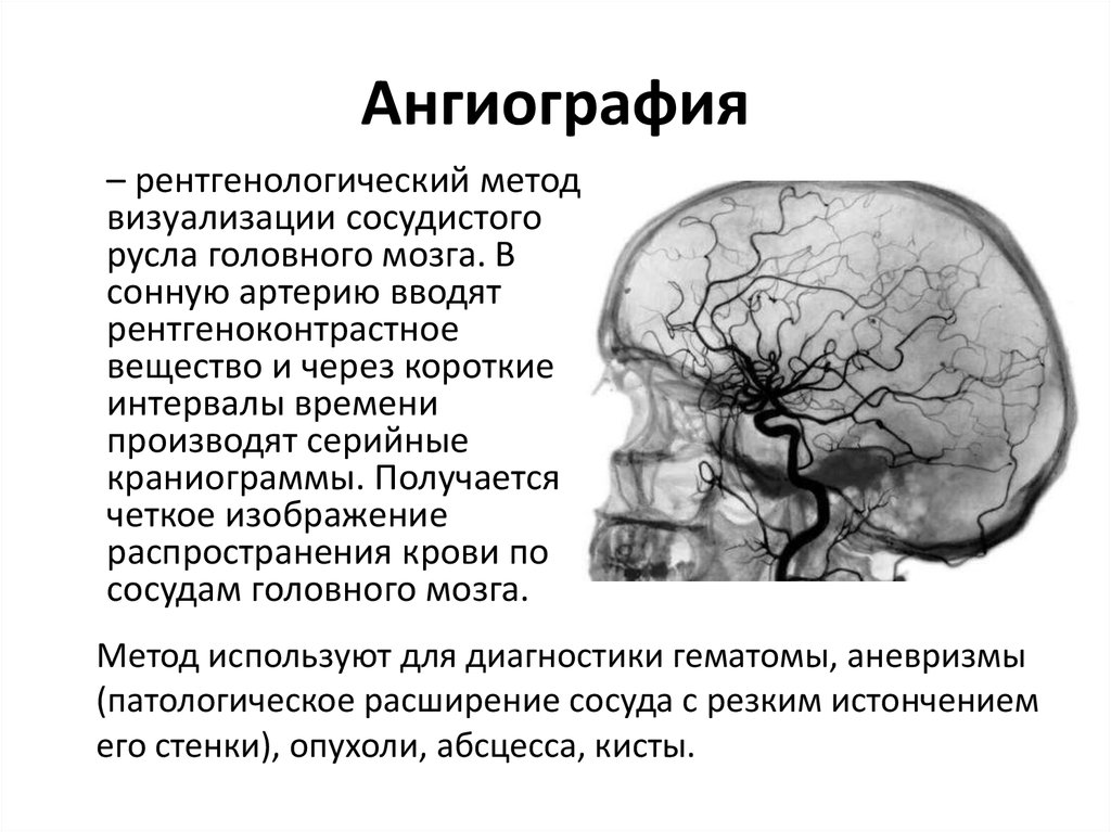 Сосуды головного мозга норма