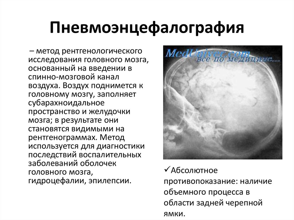 Исследование головного. Пневмоэнцефалография (ПЭГ). Методы исследования головного мозга. Рентгеноконтрастное исследование головного мозга. Вентрикулография головного мозга.