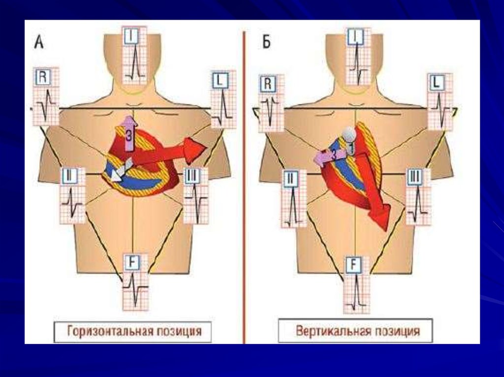 Расположены вертикально. Горизонтальное расположение сердца. Горизонтальное положение сердца. Горизонтальная позиция сердца. Вертикальное расположение сердца.