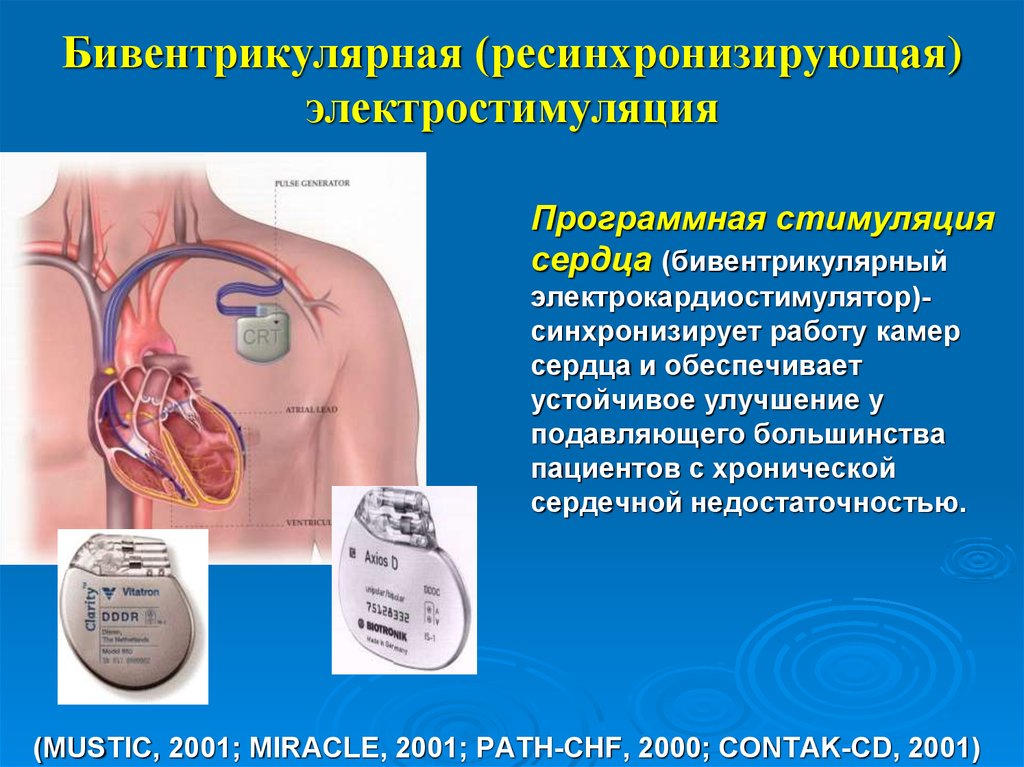Сколько живут с кардиостимулятором. Электростимулятор сердца. Электрокардиостимулятора сердца. Трехкамерный кардиостимулятор.