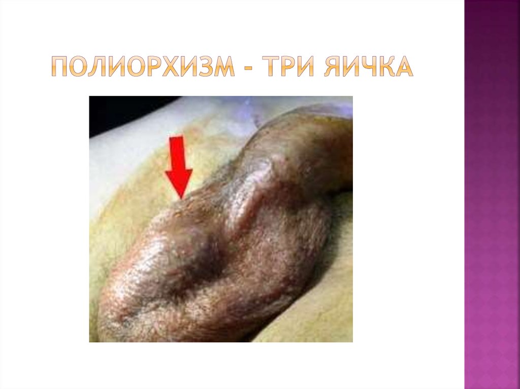 Полиорхизм - три яичка