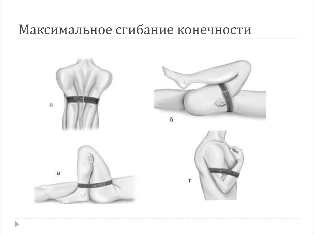 Максимальное сгибание. Максимальное сгибание конечност. Максимальноесгибание конечноти. Фиксированное сгибание конечности. Метод максимального сгибания конечности в суставе.