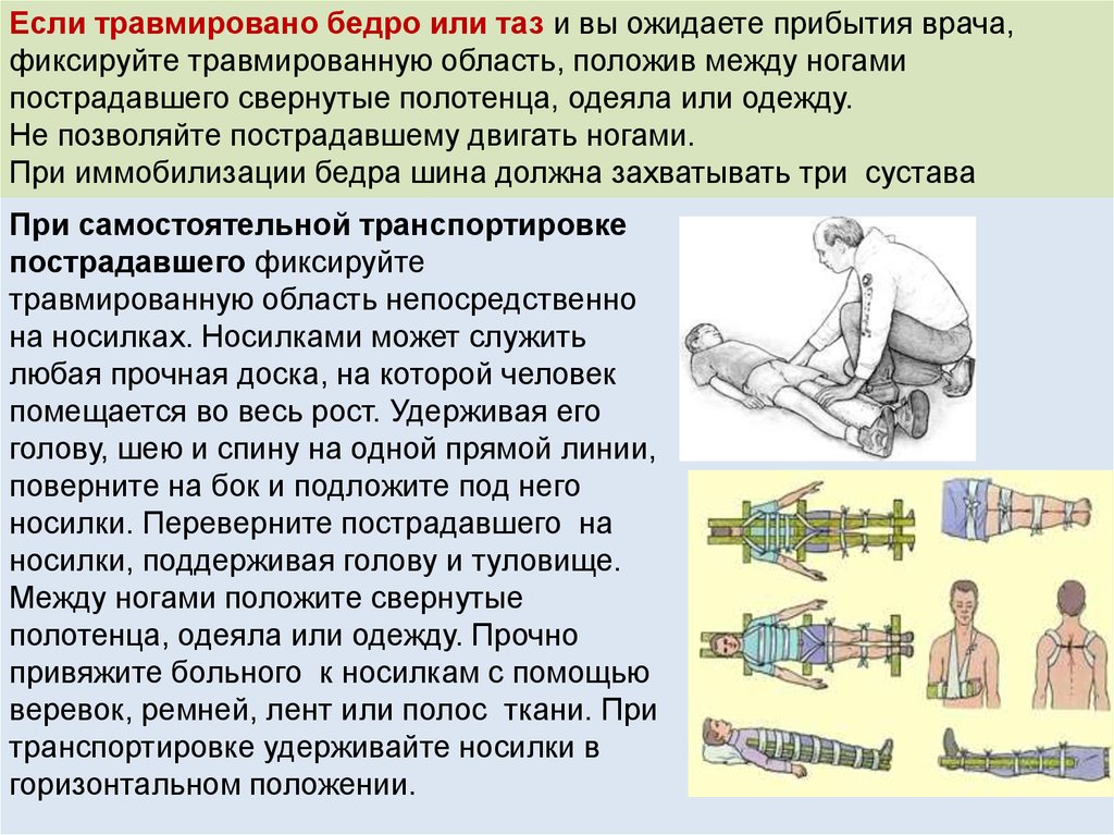 Физическая иммобилизация. При иммобилизации бедра шина должна захватывать. Перенос пострадавшего на носилках. Транспортировка на носилках.