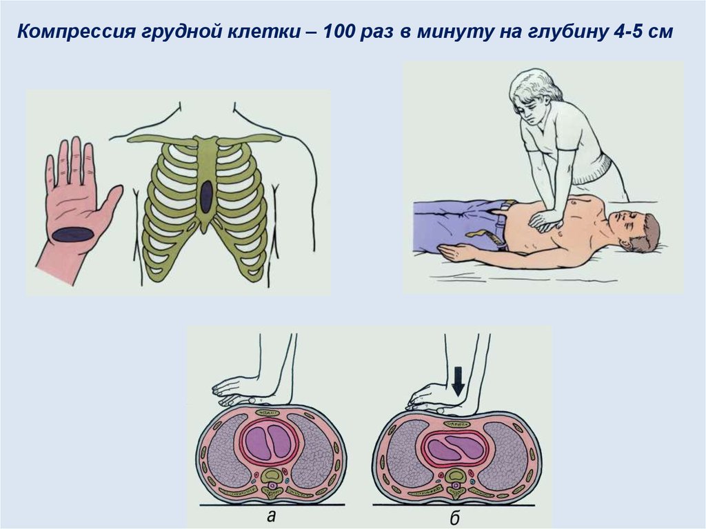 Компрессия грудной клетки. Компрессионное сжатие грудной клетки. Давление в грудной клетке. Сдавлениегрудной клетк.