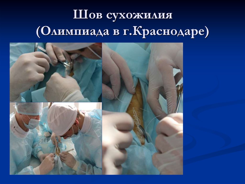 Шов сухожилия (Олимпиада в г.Краснодаре)
