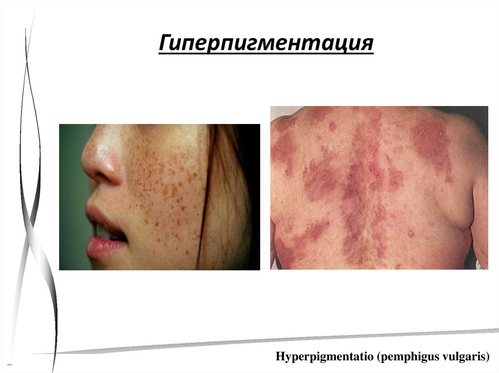 20 кожных заболеваний - презентация онлайн