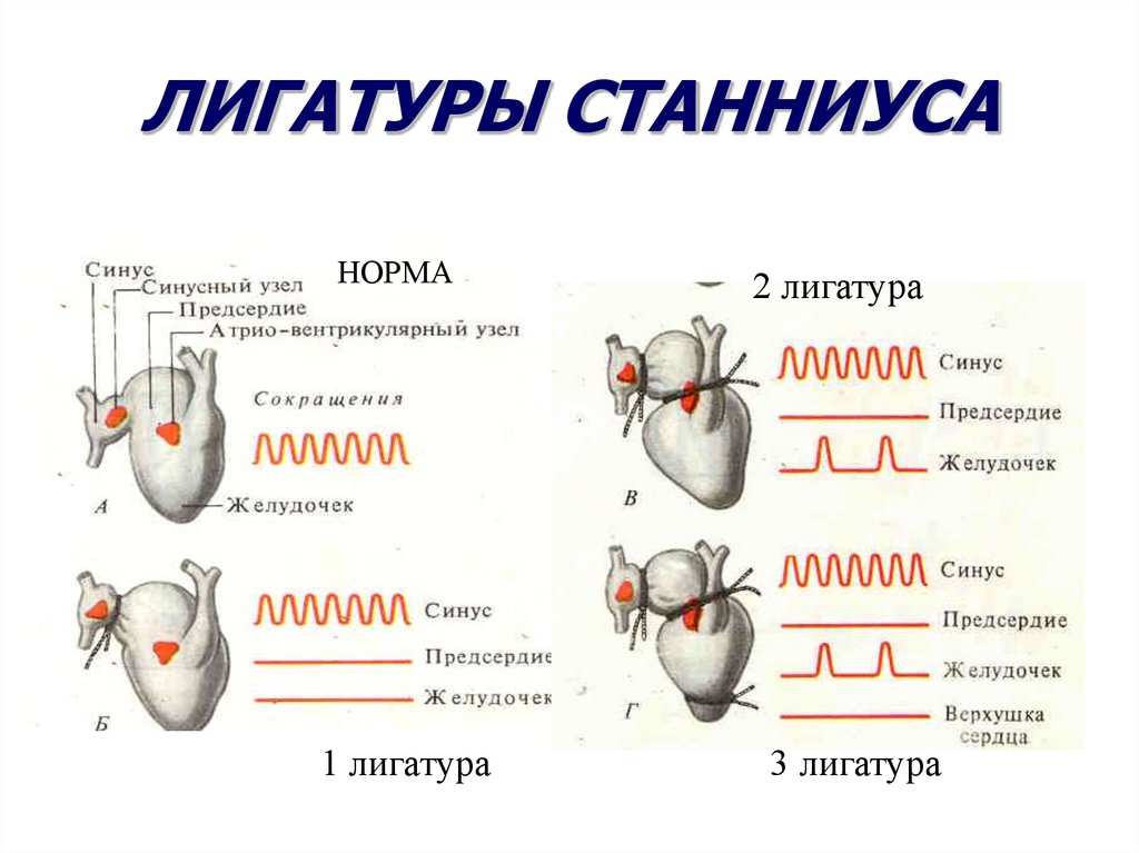 Схема наложения лигатур