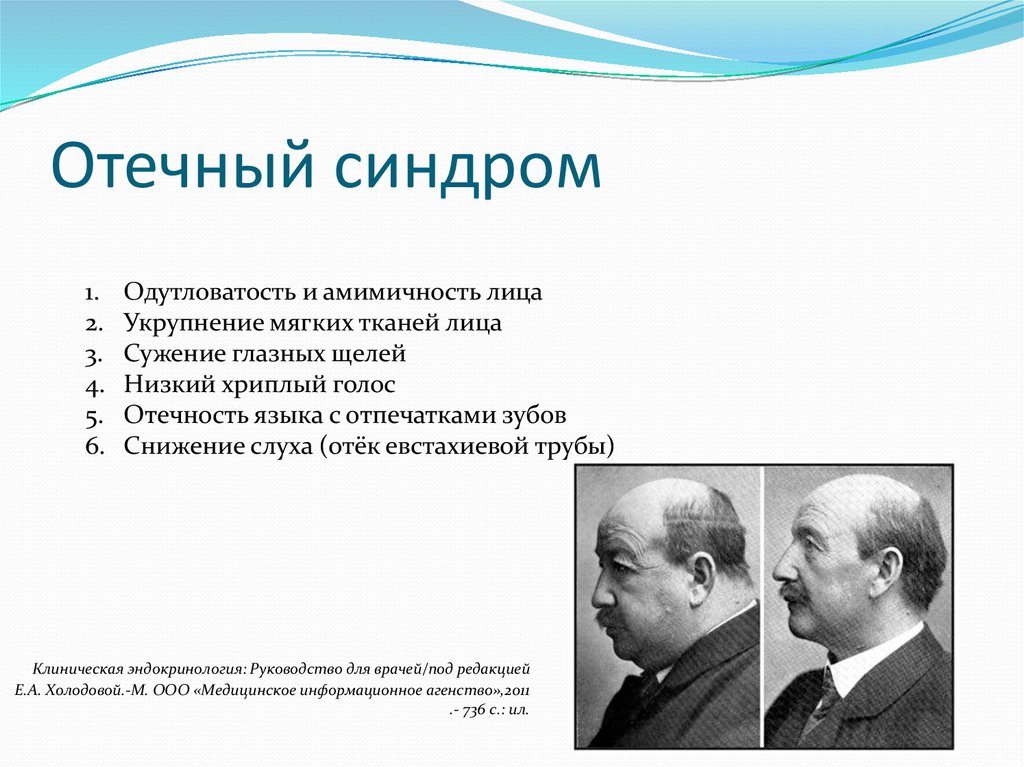 Синдром различного генеза. Отечный синдром синдром. Отечный синдром пропедевтика.