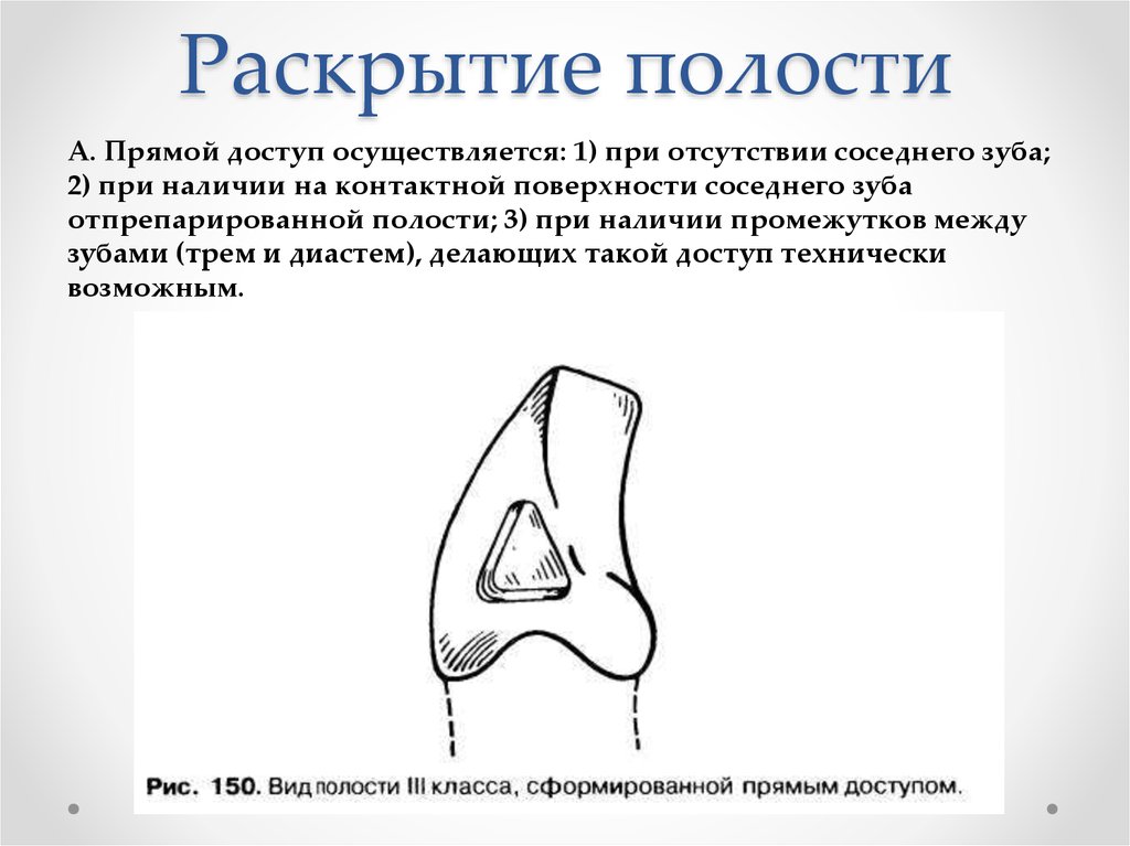 Полость поверхность. Раскрытие полости зуба. Этапы раскрытия полости зуба. Раскрытие полости прямой доступ.