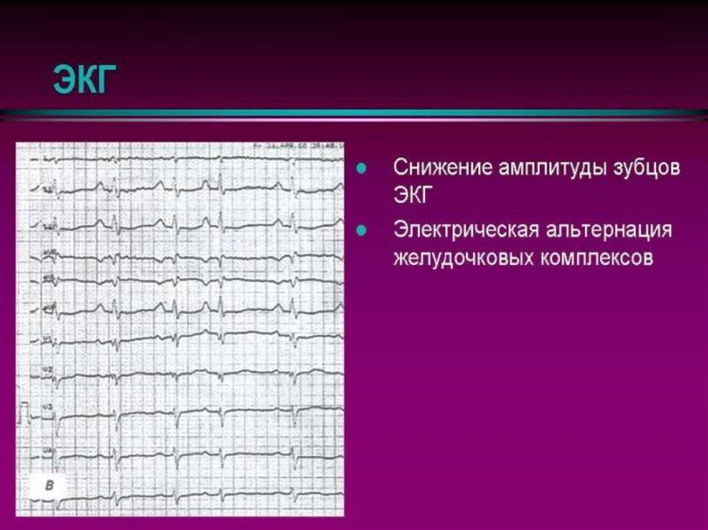 альтернация комплекса qrs. экг электрическая альтернация комплексов. альтернация комплекса qrs.