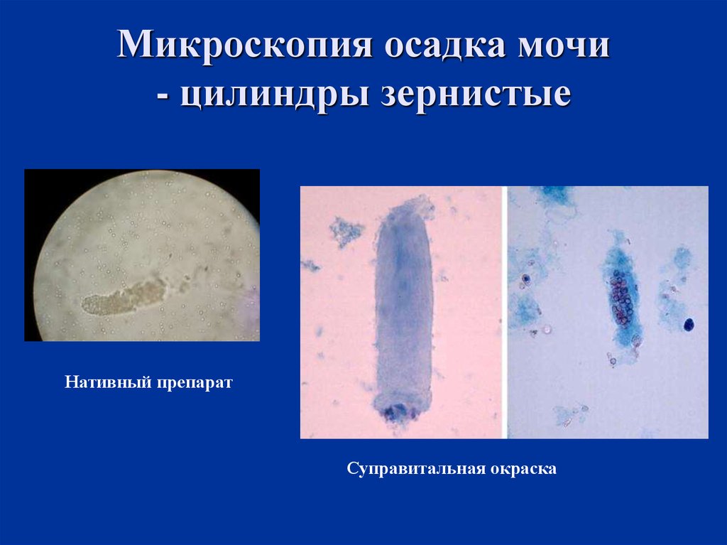 Осадки мочи микроскопия. Микроскоп я мочи цилиндр. Микроскопия осадка мочи цилиндры. Микроскопия мочицелиндры. Осадок мочи микроскопия цилиндры.