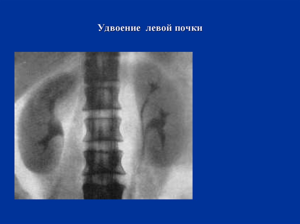 Удвоенная почка у взрослого фото