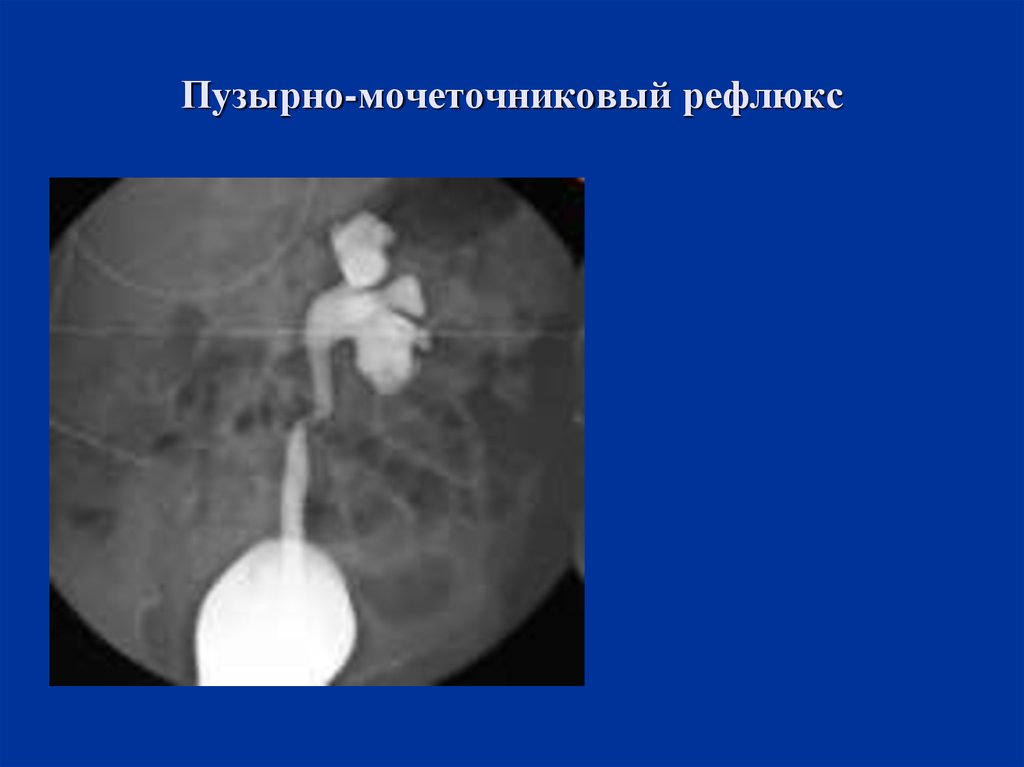 Пузырно мочеточниковый рефлюкс презентация