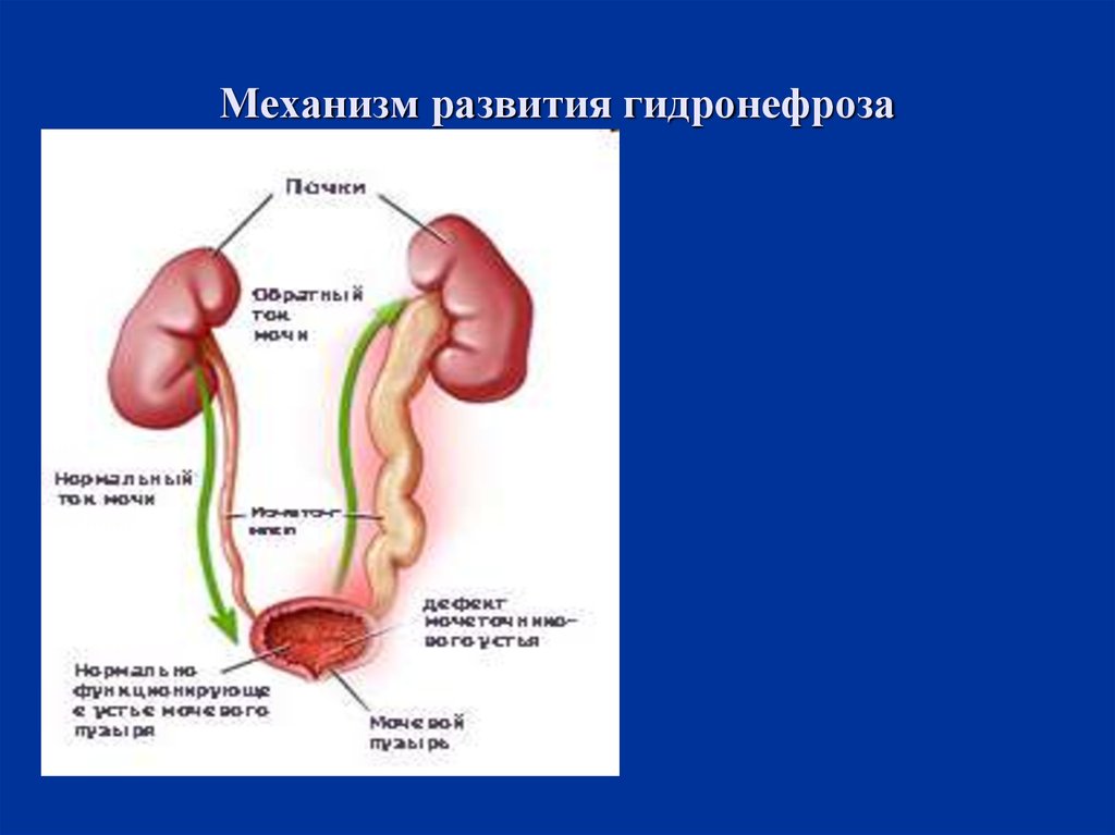 Гидронефроз у детей презентация