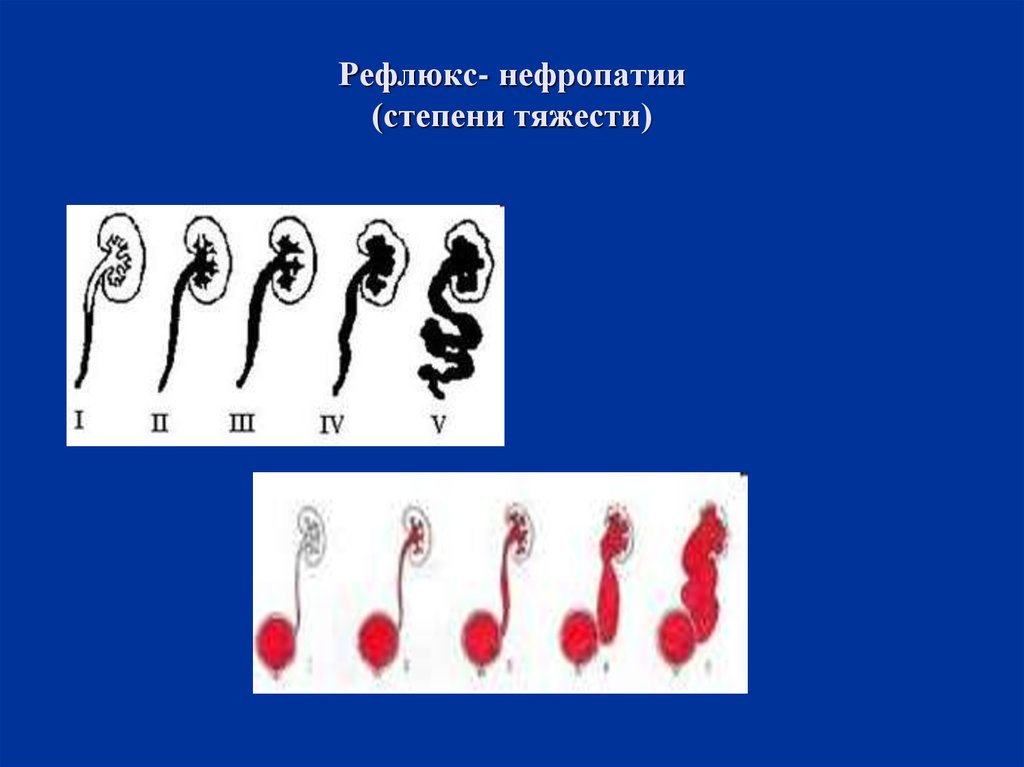 Рефлюкс пиелонефрит