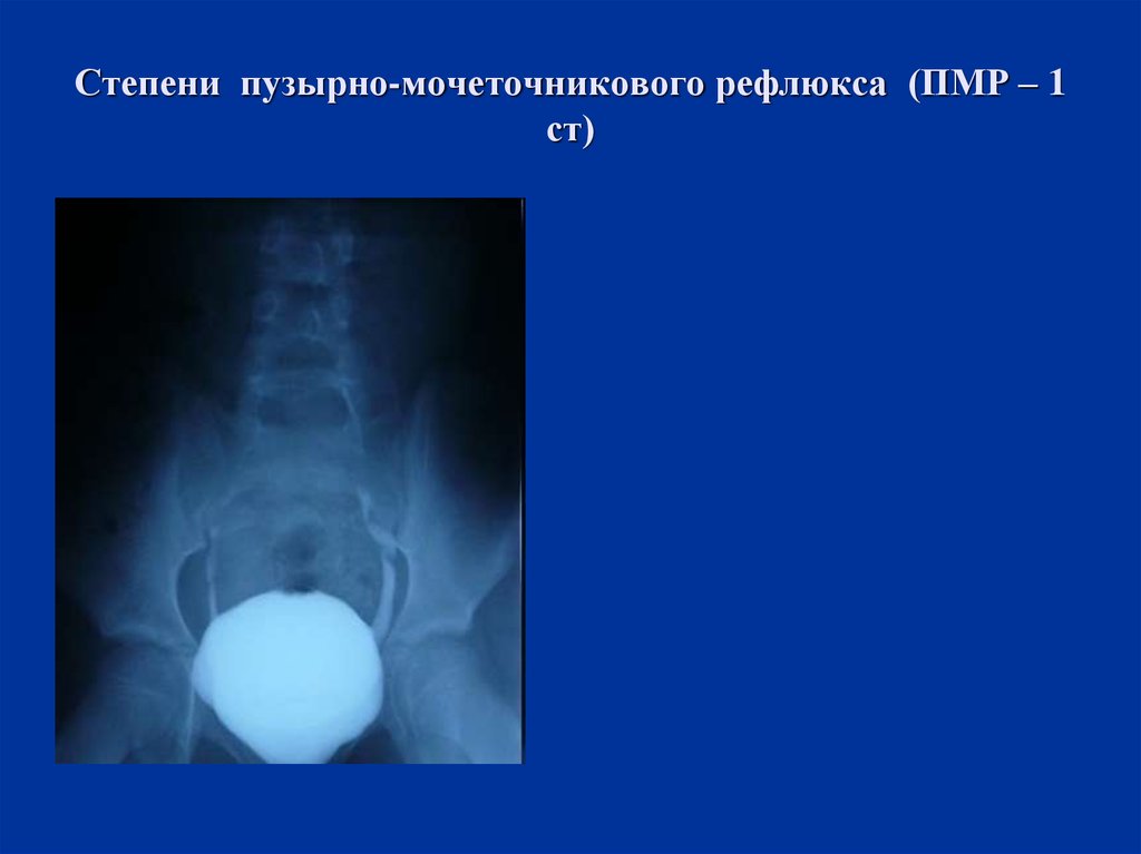 Рефлюкс у детей. Пузырно-мочеточниковый рефлюкс степени рентген. Степени пузырно-мочеточникового рефлюкса (ПМР). Пузырно-ренальный рефлюкс. Пузырно-мочеточниковый рефлюкс 1 степени рентген.